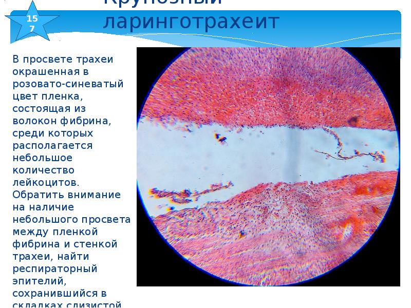 Крупозный трахеит микропрепарат рисунок