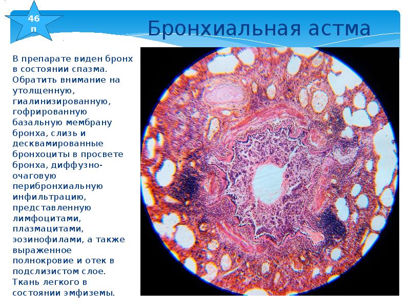 Просвет бронхов