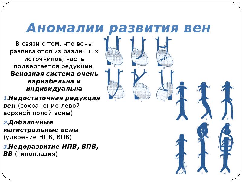 Врожденный венозный порок. Аномалии развития нижней полой вены. Нижняя полая Вена аномалии развития. Пороки развития венозной системы. Развитие вен.