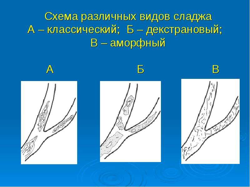 Сладж синдром рисунок