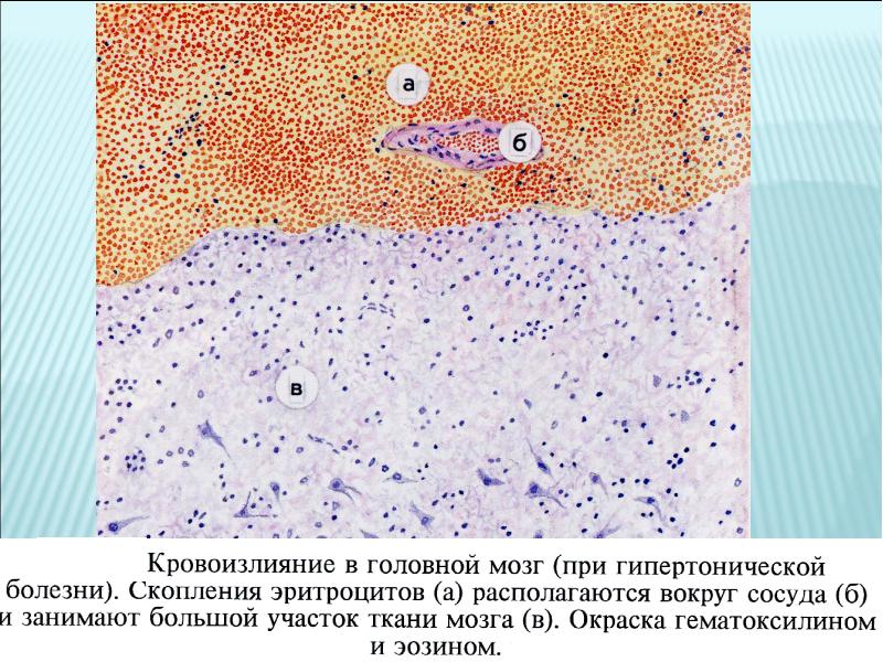 Меланома микропрепарат рисунок