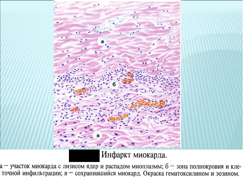 Нарушение кровообращения и лимфообращения патология презентация