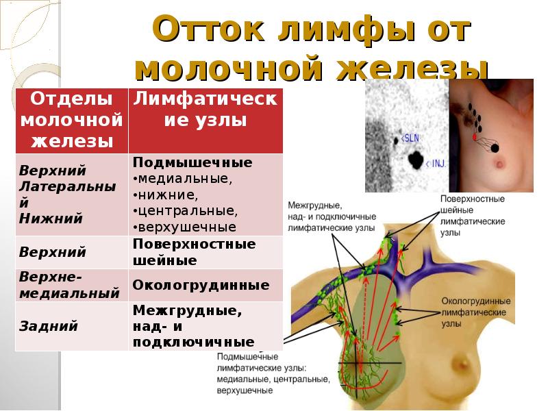 Молочные узлы. Сторожевой лимфатический узел молочной железы. Лимфатические узлы молочной железы(по квадрантам). Пути лимфооттока молочной железы.