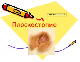 Плоскостопие