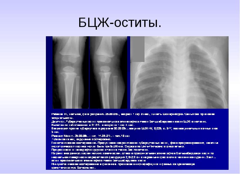 Презентация иммунодиагностика туберкулеза