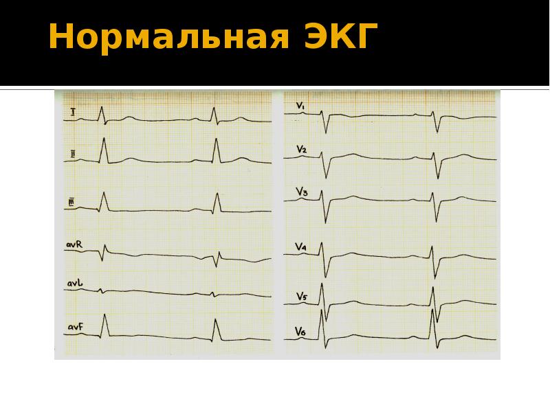 Метаболические изменения на экг. ЭКГ ритм синусовый отклонение ЭОС. ЭКГ гипертрофия левого желудочка ритм синусовый отклонение ЭОС влево. ЭКГ С ЧСС 110 ритм синусовый электрическая ось не отклонена. Ритм синусовый ЭОС не отклонена.