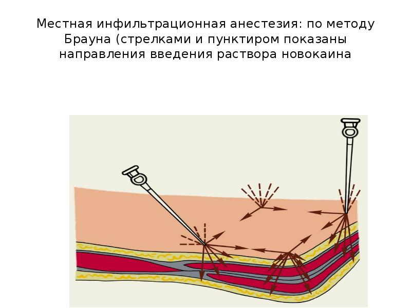 Местное обезболивание