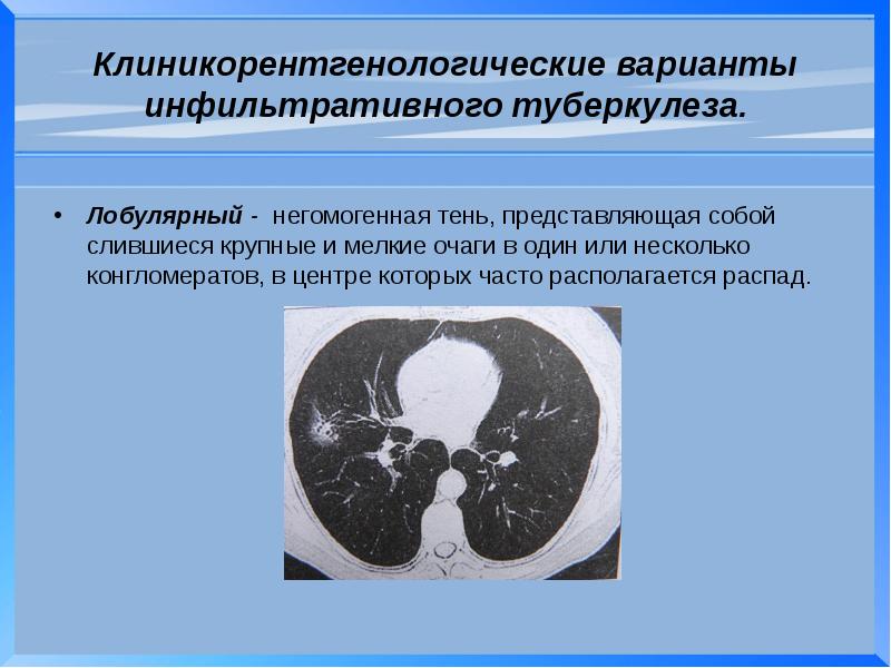 Туберкулез чло презентация