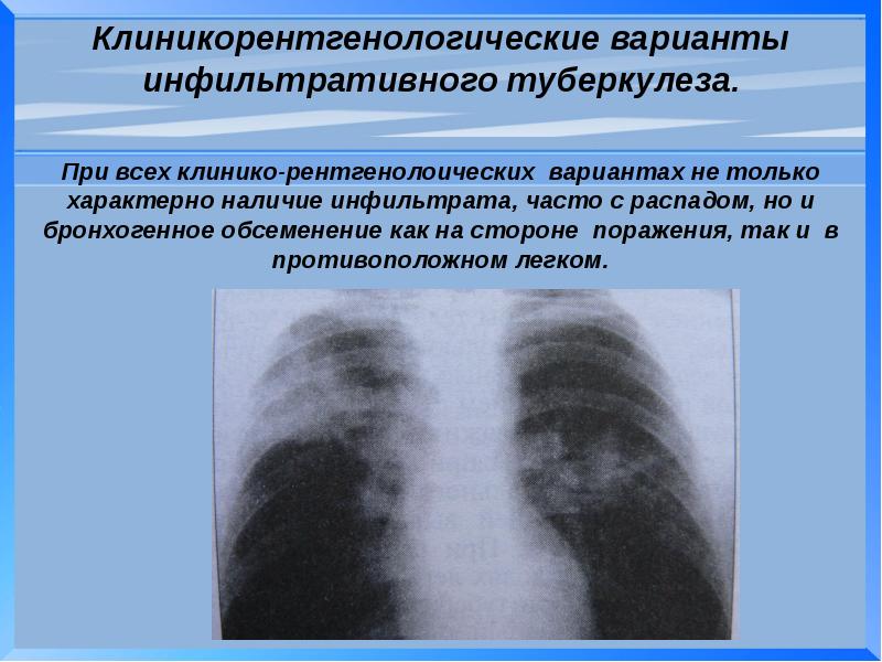 Инфильтративный туберкулез в фазе распада клиника