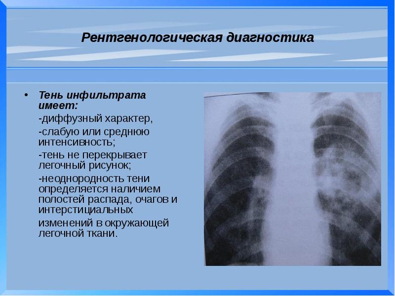 Усилен легочный рисунок в прикорневых и базальных отделах что это