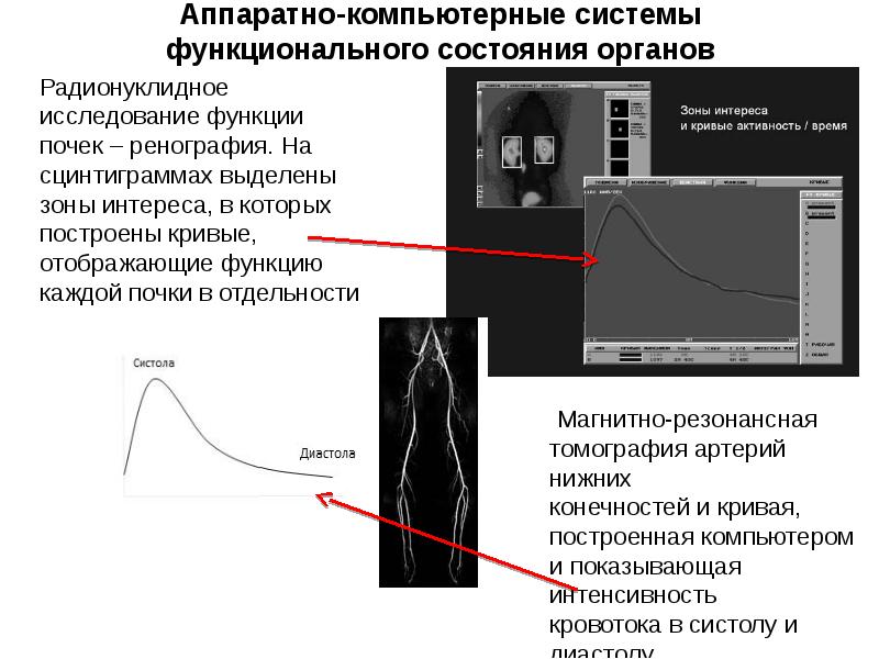 Криво отображается. Радионуклидное исследование почек. Аппаратно-компьютерные медицинские системы. Ренография функциональная кривая. Механизм радионуклидного исследования почек.