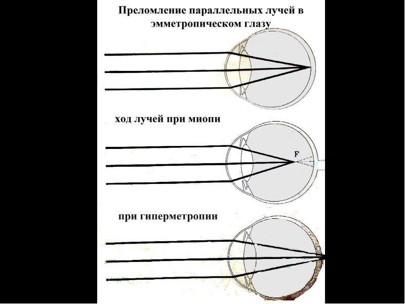 Изучите физиологию зрения рассмотрите схемы рефракции при нормальном зрении