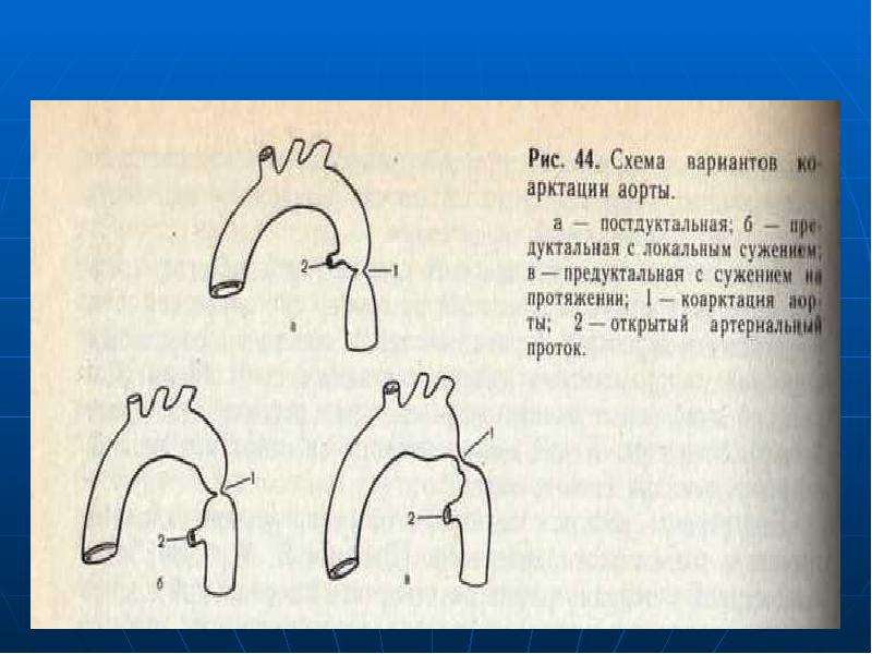 Коарктация аорты презентация