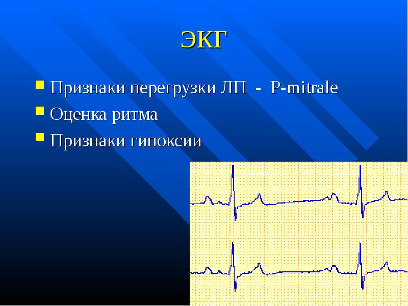 Экг при отеке легких фото