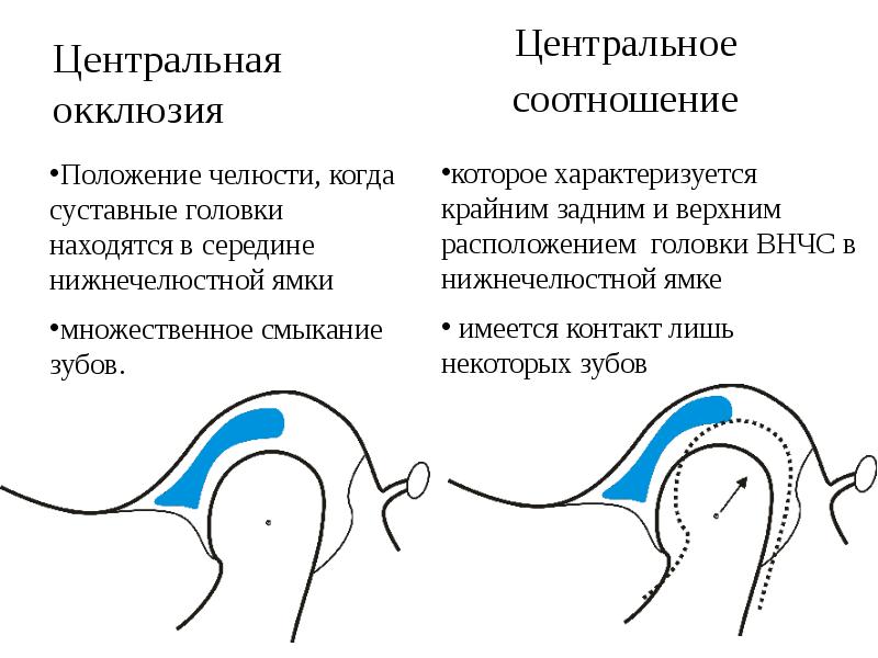 Центральная окклюзия и центральное соотношение. Центральное соотношение челюстей. Центральное соотношение челюстей это в стоматологии. Центральная окклюзия и центральное соотношение челюстей.