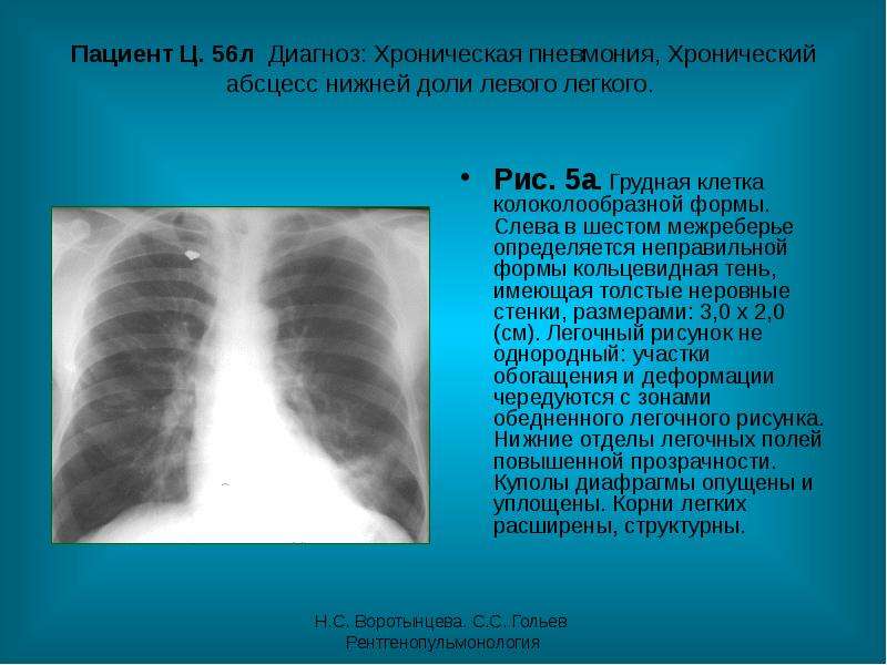 Легочный рисунок усилен за счет сосудистого компонента что это