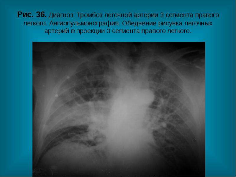 Обеднение сосудистого рисунка легких характерно для