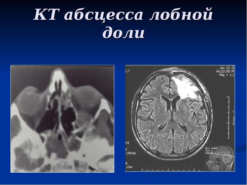 Отогенный менингит презентация