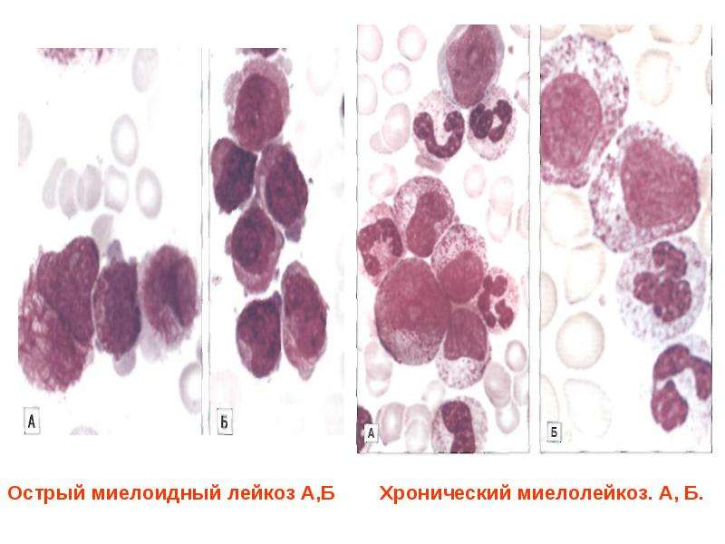 Острый миелобластный лейкоз фото
