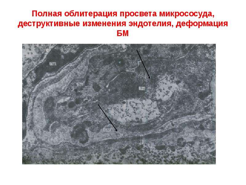 Облитерация синусов. Облитерация просвета бронхов. Уменьшение просвета микрососудов причины. Облитерация в гидравлике.