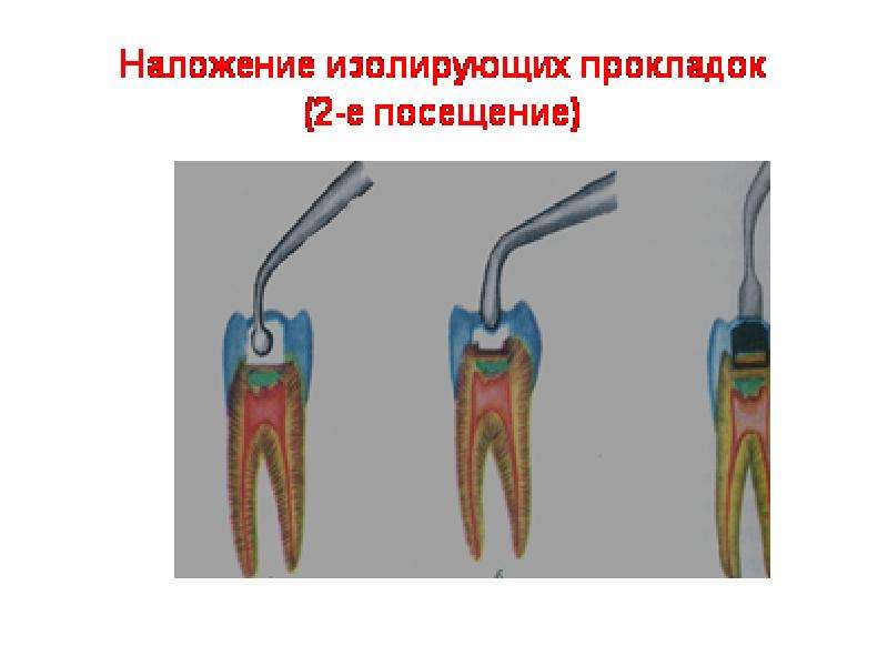 Лечебные и изолирующие прокладки в стоматологии презентация