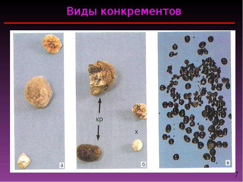 Конкременты это. Разновидности конкрементов.