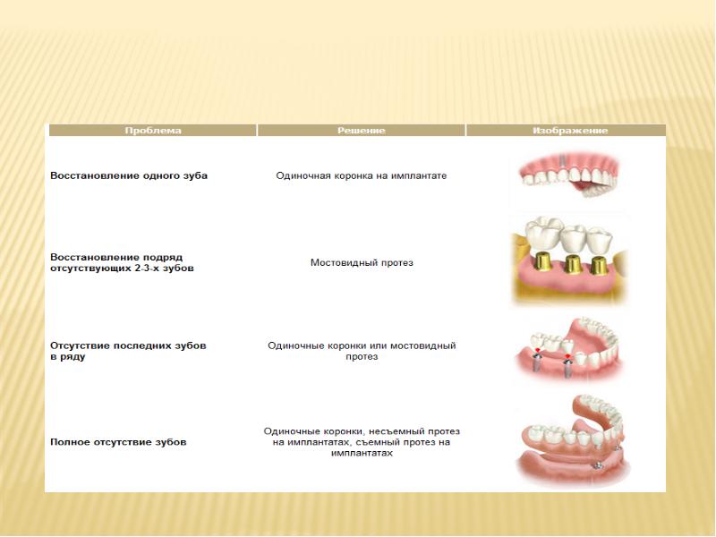 Этапы имплантации зубов презентация