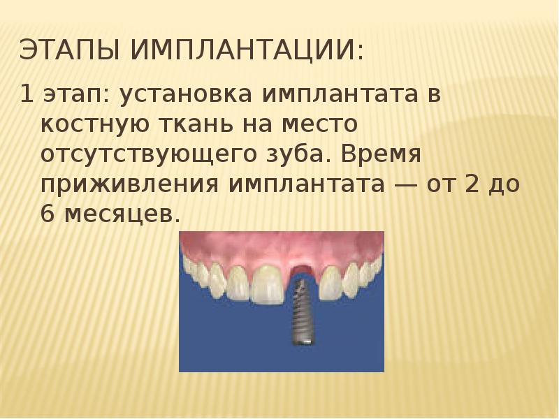 История имплантации зубов презентация