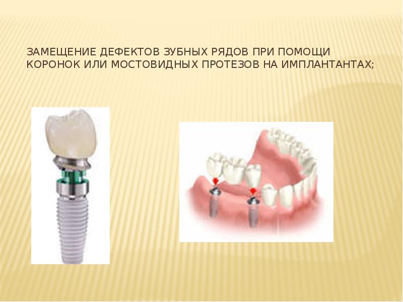 Презентация ортопедия коронки