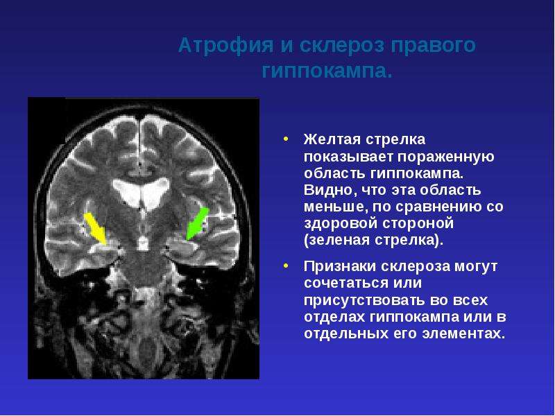 Презентация атрофия и склероз