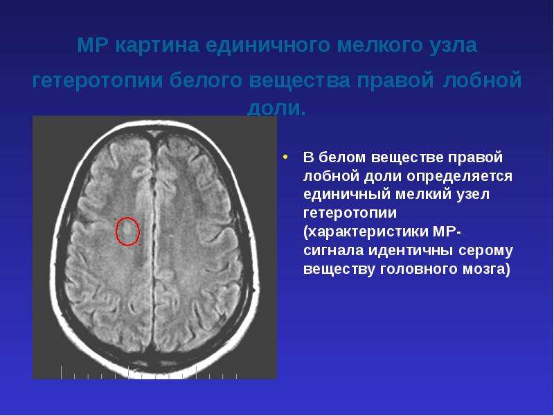 Очаговые вещества мозга. Резидуальные очаги лобных долей. Единичный субкортикальный очаг в правой лобной доле. Белое вещество лобных долей. Гетеротопия серого вещества мрт.