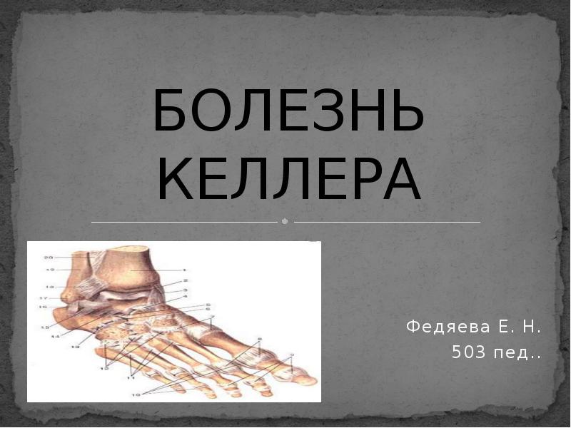Болезнь келлера стопы. Остеохондропатия ладьевидной кости болезнь Келлера. Келлер 1 и остеохондропатия. Ладьевидная кость стопы болезнь Келлера.