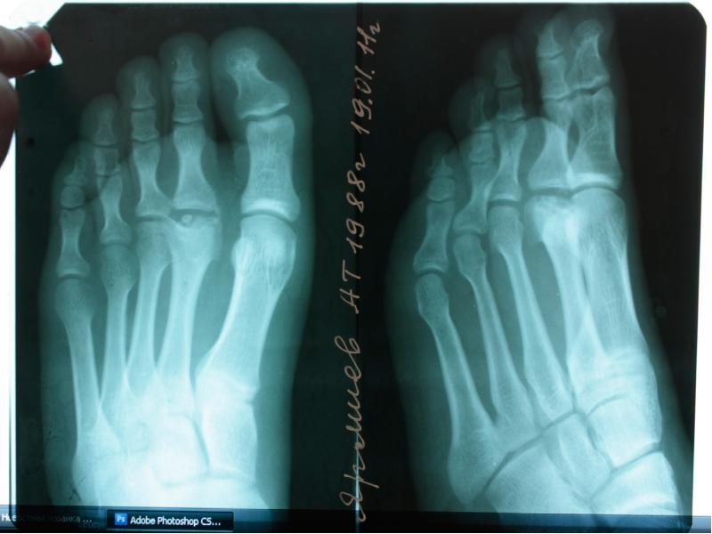 Болезнь келлера стопы. Остеохондропатия ладьевидной кости Келлер 1. Болезнь Келлера 2 рентген. Остеохондропатия головки 1 плюсневой кости.