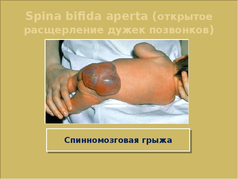 Spina bifida aperta (открытое расщерление дужек позвонков)