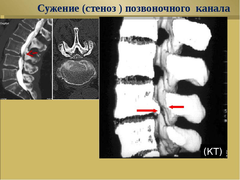 Стеноз отдела позвоночника