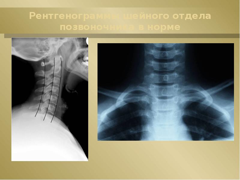 Рентгенограммы шейного отдела позвоночника в норме