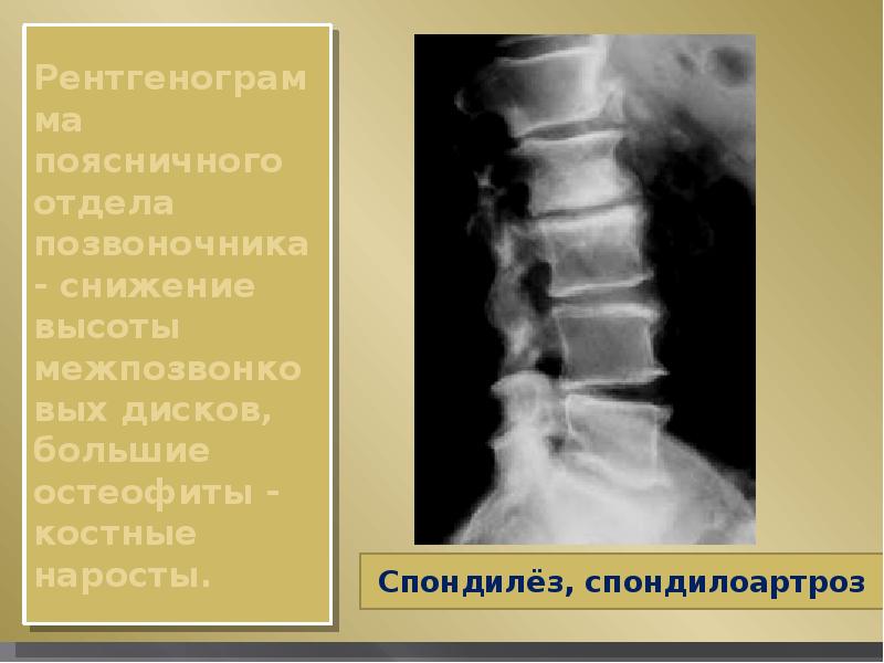 Рентгенограмма поясничного отдела позвоночника - снижение высоты межпозвонковых дисков, большие осте