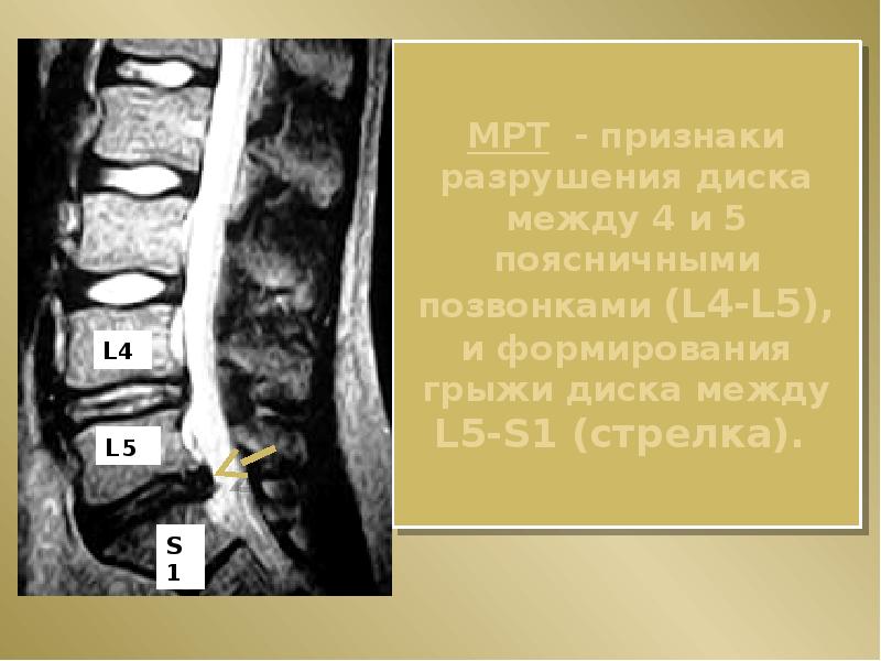 МРТ - признаки разрушения диска между 4 и 5 поясничными позвонками (L4-L5), и формирования грыжи дис