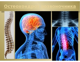Остеохондроз позвоночника для курсантов и студентов