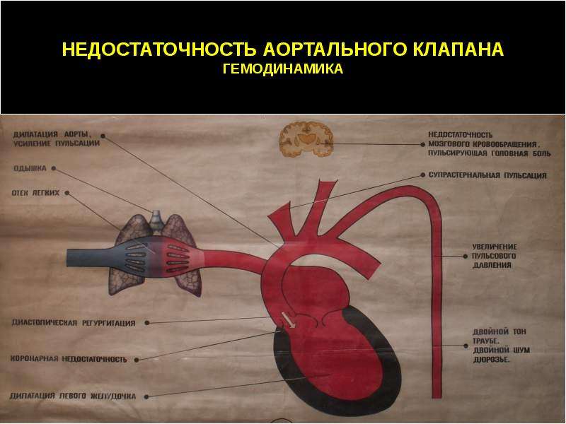 Аортальные пороки презентация