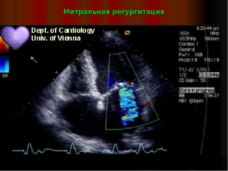Аортальная регургитация. ЭХОКГ при регургитации митрального. Митральная недостаточность доплер эхокардиография. ЭХОКГ при аортальной регургитации. Допплерография регургитация.