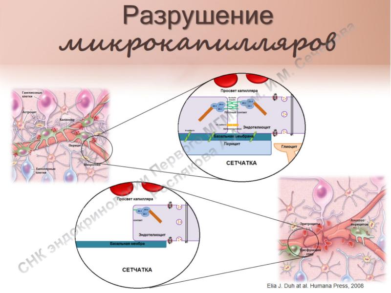 Диабетическая ретинопатия код по мкб