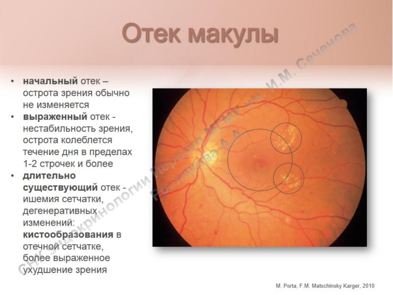 Диабетическая ретинопатия рекомендации