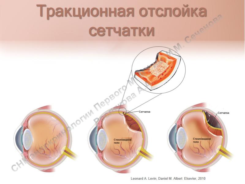 Регматогенная отслойка сетчатки глаза