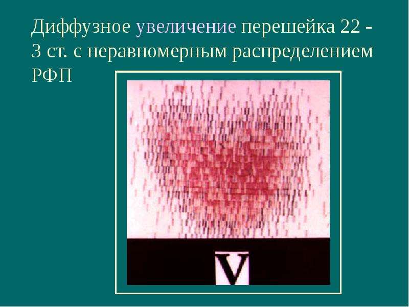 Неравномерная диффузная. Диффузно неравномерное распределение РФП что это. Диффузное накопление РФП. Диффузное повышение накопления РФП.