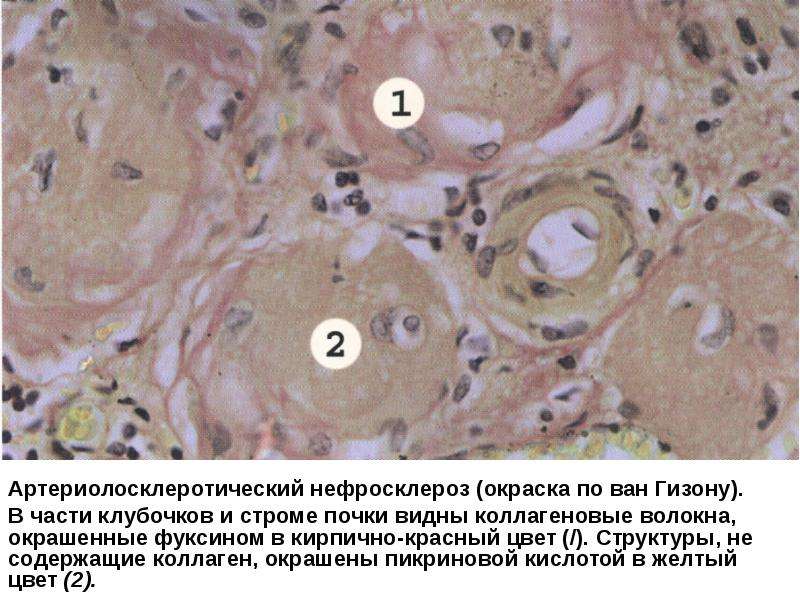 Артериолосклеротический нефросклероз микропрепарат рисунок