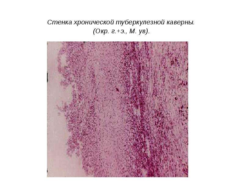 Строение стенки каверны