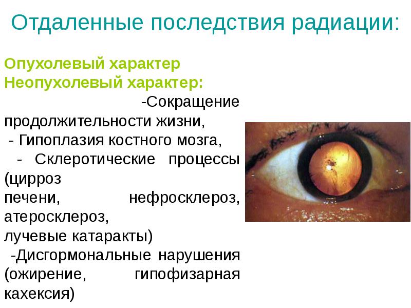 Отдаленные последствия. Последствия радиационного облучения. Отдаленные последствия радиационного облучения. Радиационная катаракта. Неопухолевые последствия облучения.