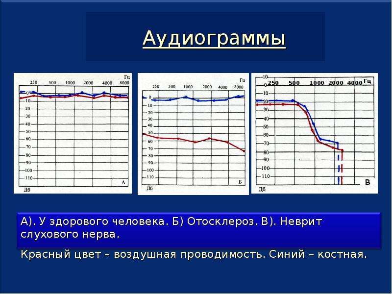 Нормальная аудиограмма фото