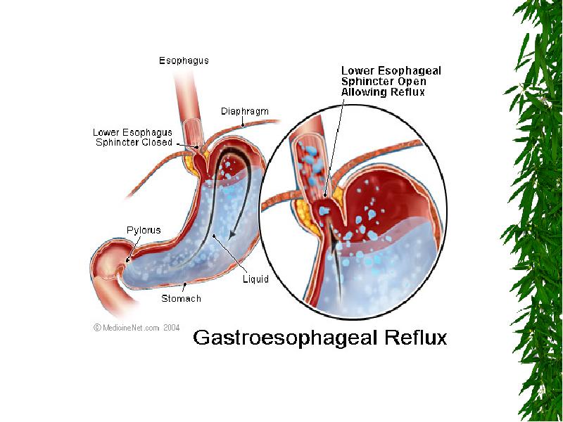 Гастроэзофагеальная рефлюксная болезнь презентация